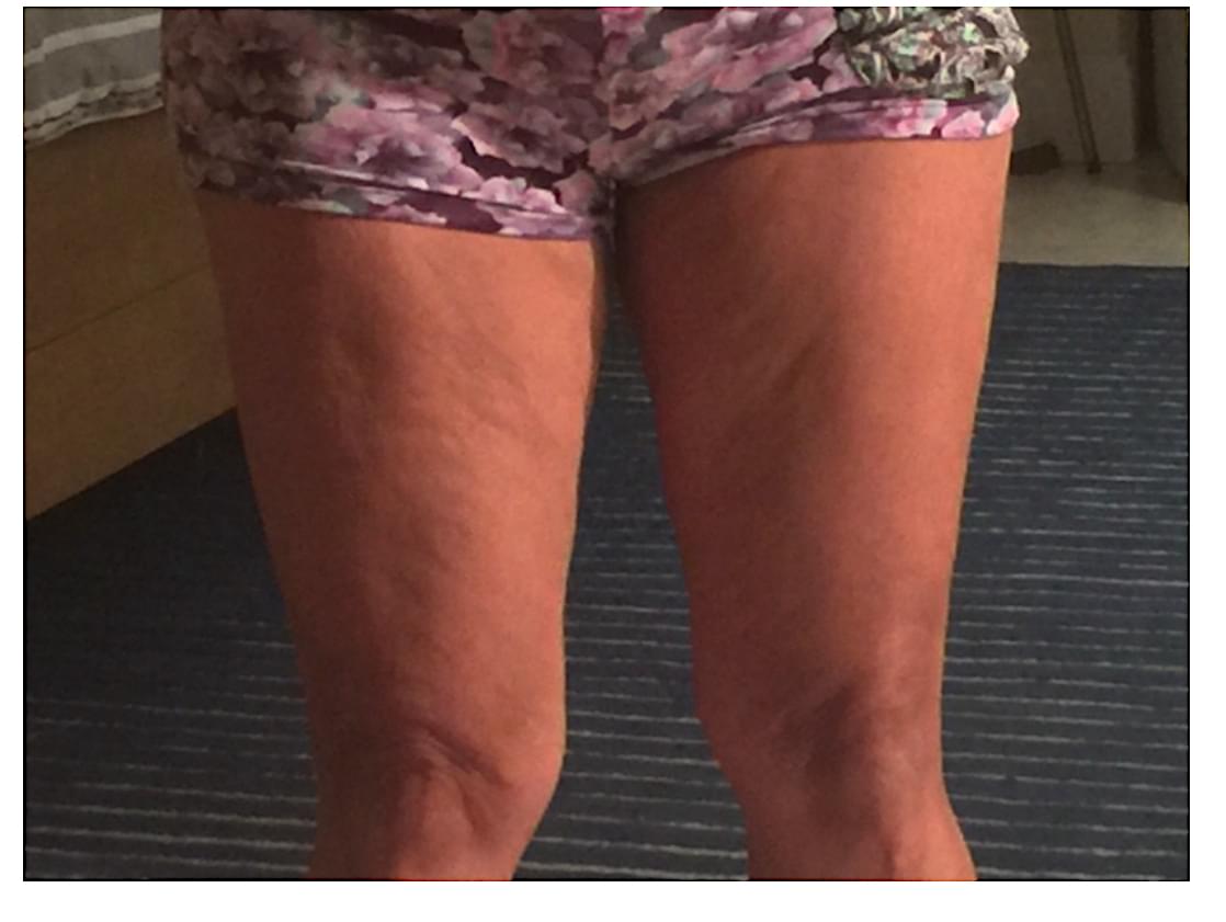 what makes cellulite worse
