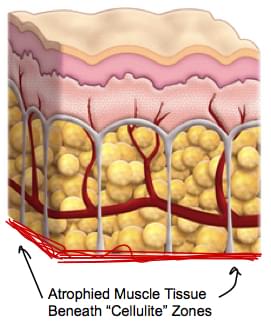 atrophied muscle layer under cellulite skin dimples and shadows