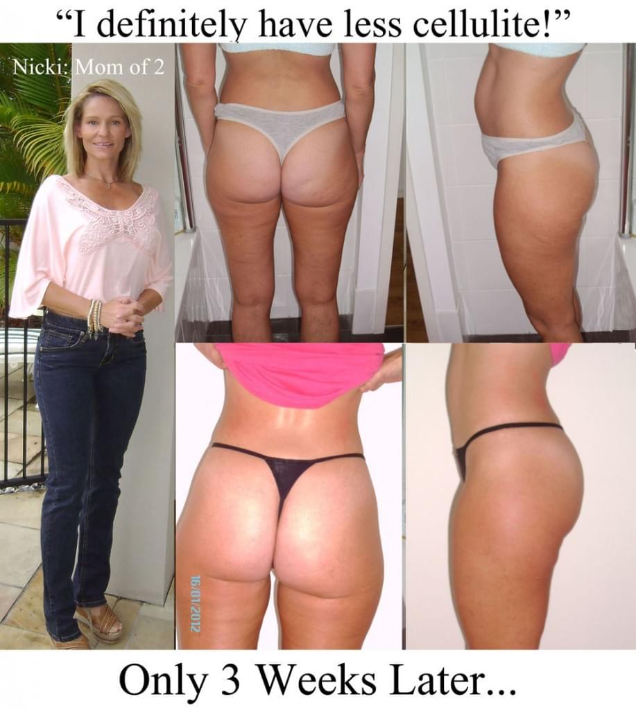 Nicki's cellulite before and after photos and success story
